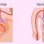 What is Varicocele and How it is Related to Infertility?