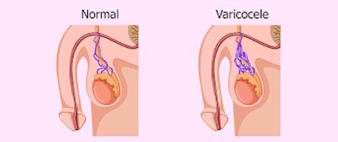 varicocele cause male infertility