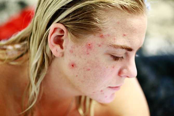 protect skin from acne