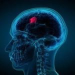What Kind of Headaches Are Associated with Brain Tumors?