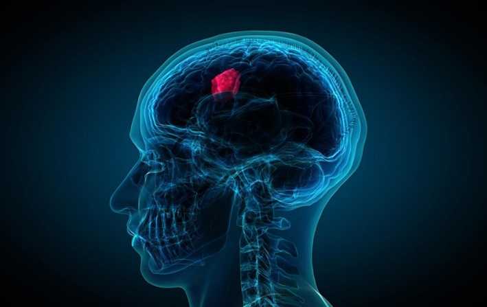 brain tumour treatment price