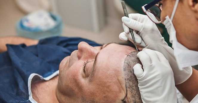 hair replacement in syracuse ny