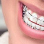 Get That Beautiful Smile Back, With Affordable Orthodontic Braces