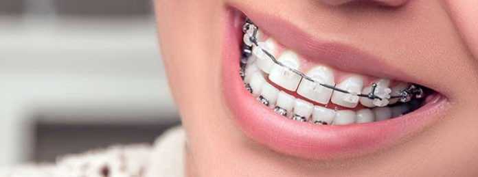 cheap orthodontic braces