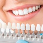 5 Mistakes to Avoid When You're Opting for Teeth Whitening Services