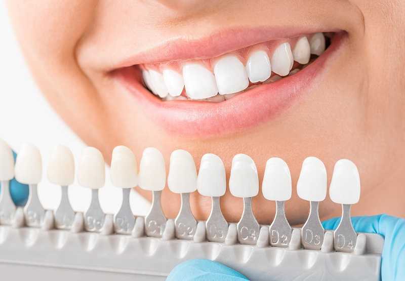 teeth whitening services near me