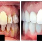 How Can You Change Your Life through Full Mouth Restoration?