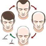 Considering A Hair Transplant? This Is How Much You’ll Have To Pay