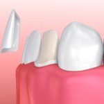 The Various Kinds Of Dental Veneer You Must Know