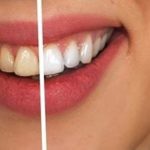Can Regular Tooth Whitening Damage Your Teeth? Here's What You Should Know