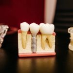 Lost a Tooth? 4 Affordable Ways to Fill in the Gap