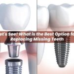Let’s See! What is the Best Option for Replacing Missing Teeth