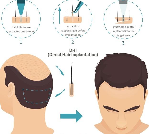 hair restoration procedures