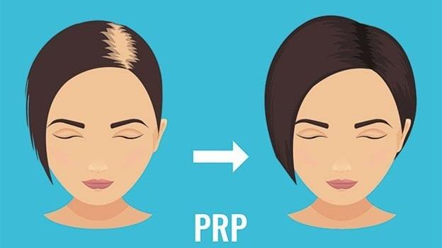 prp therapy for hair loss
