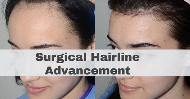 surgical hairline advancement