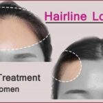 Hairline Lowering Surgery- Perfect Treatment for Women
