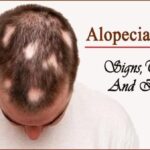 Alopecia Areata? Signs, Treatments and its Results