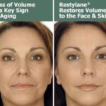 Guide To Know Everything About Face Fillers