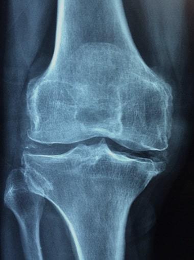 osteoporosis - knee cartilage damage x ray