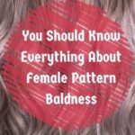 You Should Know Everything About Female Pattern Baldness