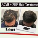 ACell + PRP: Permanent Non-Surgical Solution for Hair Loss