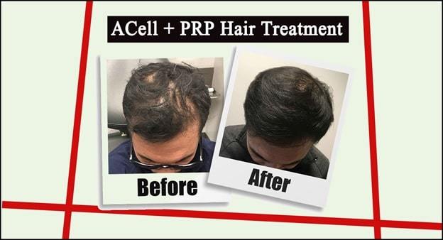 prp acell hair treatment