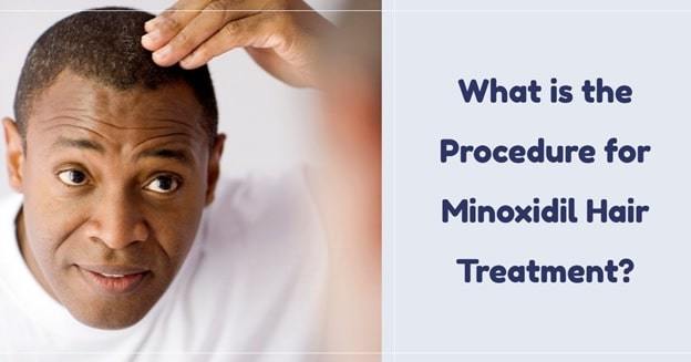 minoxidil treatment