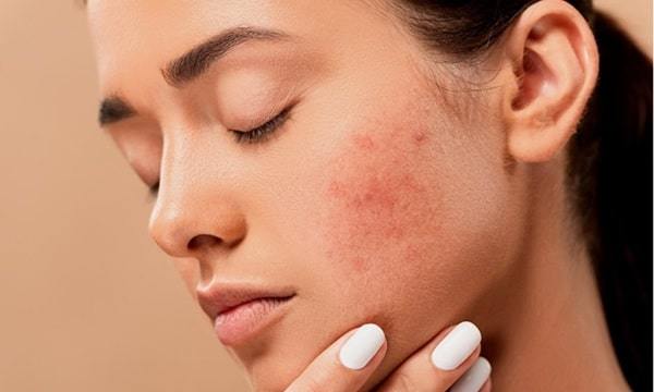 side view of woman’s face with visible acne scars